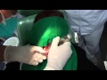 EXODONCIA DE REMANENTE RADICULAR, INCISIVO INFERIOR DERECHO