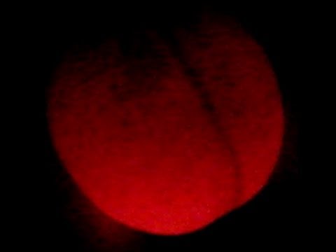 Transillumination Test For Hydrocele - YouTube