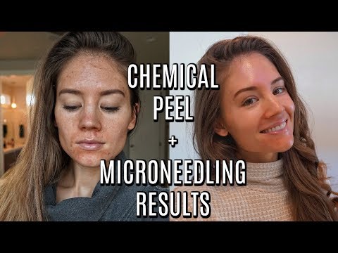 I DID A CHEMICAL PEEL + MICRONEEDLING