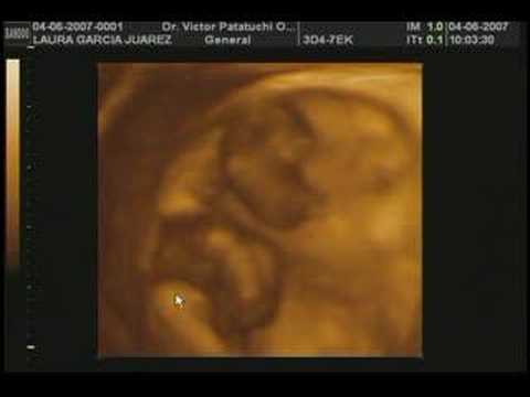 ULTRASONIDO 4D EMB. GEMELAR 8 SEMANAS - YouTube ULTRASONIDO 4D EMB. GEMELAR 8 SEMANAS - YouTube