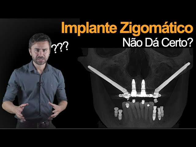 É Por Isso Que Implante Zigomático Não Dá Certo! - Bizarrices Científicas