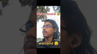Beard Transplant