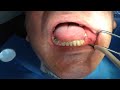 Dişe implant nasıl yapılır?