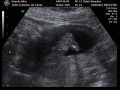 My Baby Boy / Ultrasound 2d/4d Part 1, 4/2/2013, 13 1/2 Weeks