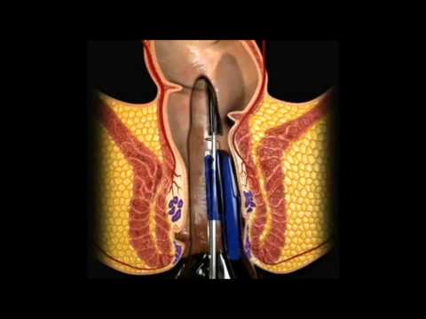 Come fare una candela di patata da emorroidi