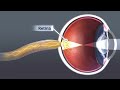 Animation: Cataract