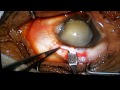 SICS (Small Incision Cataract Surgery) by Dr Shivaprasad Sahoo