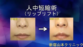 人中短縮術(リップリフト、上口唇短縮術)を写真でわかりやすく解説