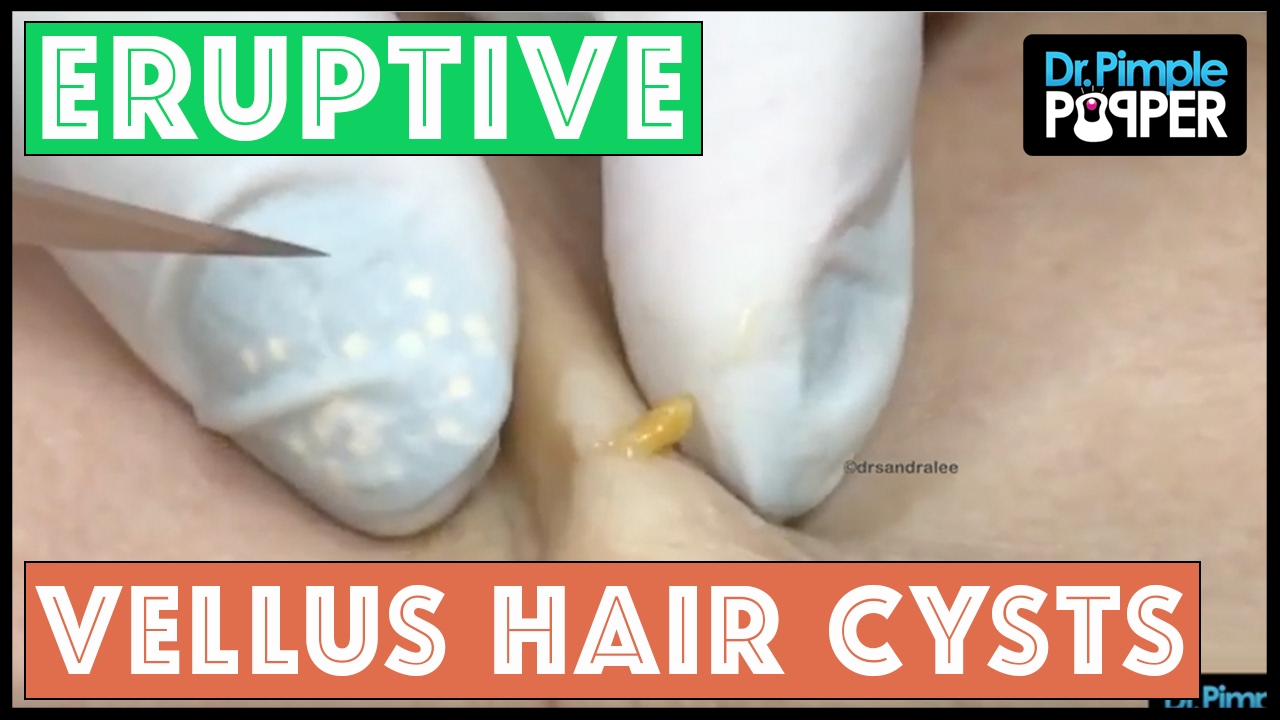 Dome shaped pimple anus