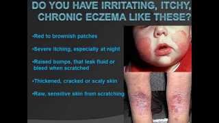 Over the counter eczema cream with steroids