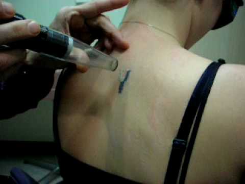 Lindsay from Disappearing Ink in Toronto is getting HER tattoo removed by a lindsay lohan tattoo la bella vita meaning. Lindsay from Disappearing Ink in Toronto is getting HER tattoo removed by a