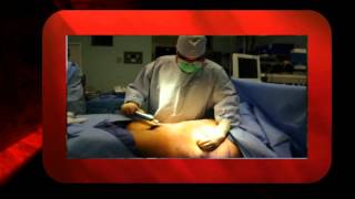 Brazilian butt lift - Not a candidate for surgery - Houston, Dallas, San Antonio, Austin