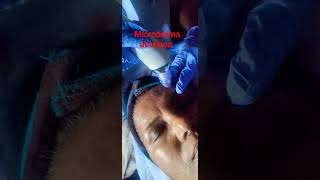 Hydrafacial- Microderma Abrasion ..