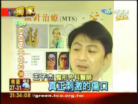 王子杰醫師：微針滾輪治痘疤、毛細孔、細紋