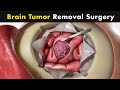 How Brain Tumor Surgery is performed? (Urdu/Hindi)