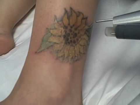 Los Angeles Tattoo Removal - Removal of Flower Tattoo on Ankle at Dr ...