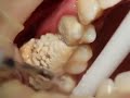 Limpieza dental ultrasonido