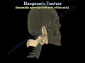 Hangman's Fracture - Everything You Need To Know - Dr. Nabil Ebraheim