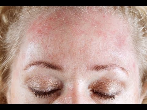 Los baños con la infusión de la celidonia mayor a la psoriasis