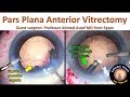how to perform a pars plana anterior vitrectomy in cataract surgery