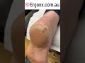 Painful cracked heel removal in the clinic