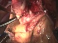 Aortic Valve Replacement: Operative Technique. Arie Blitz, MD