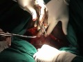 Caesarean Section: Division of the uterovesical peritoneum and incision into the lower uterine segme