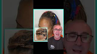 Scalp Micropigmentation For African American Women Natural Hairline Restoration In Tampa