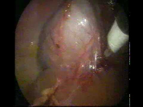 No scar Laparoscopic