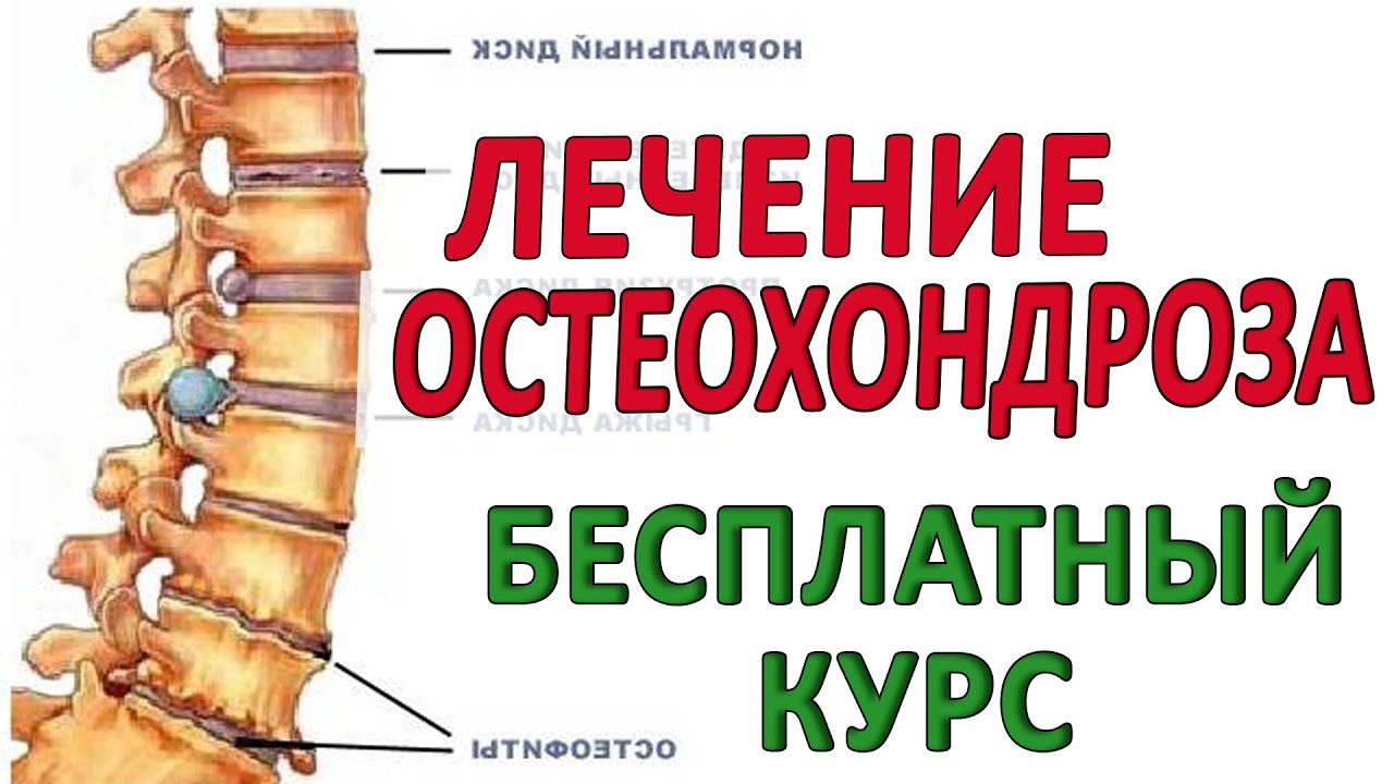 Остеохондроз грудного отдела в домашних условиях Остеохондроз грудного отдела в домашних условиях