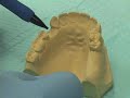 Placing Implant Abutments