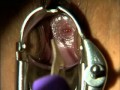 NEJM Pelvic Examination