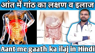 आत म गठ क लकषण Aant Me Ganthh Ka Ilaj In Hindi Intestinal Obstructionwhatsapp 9473602447