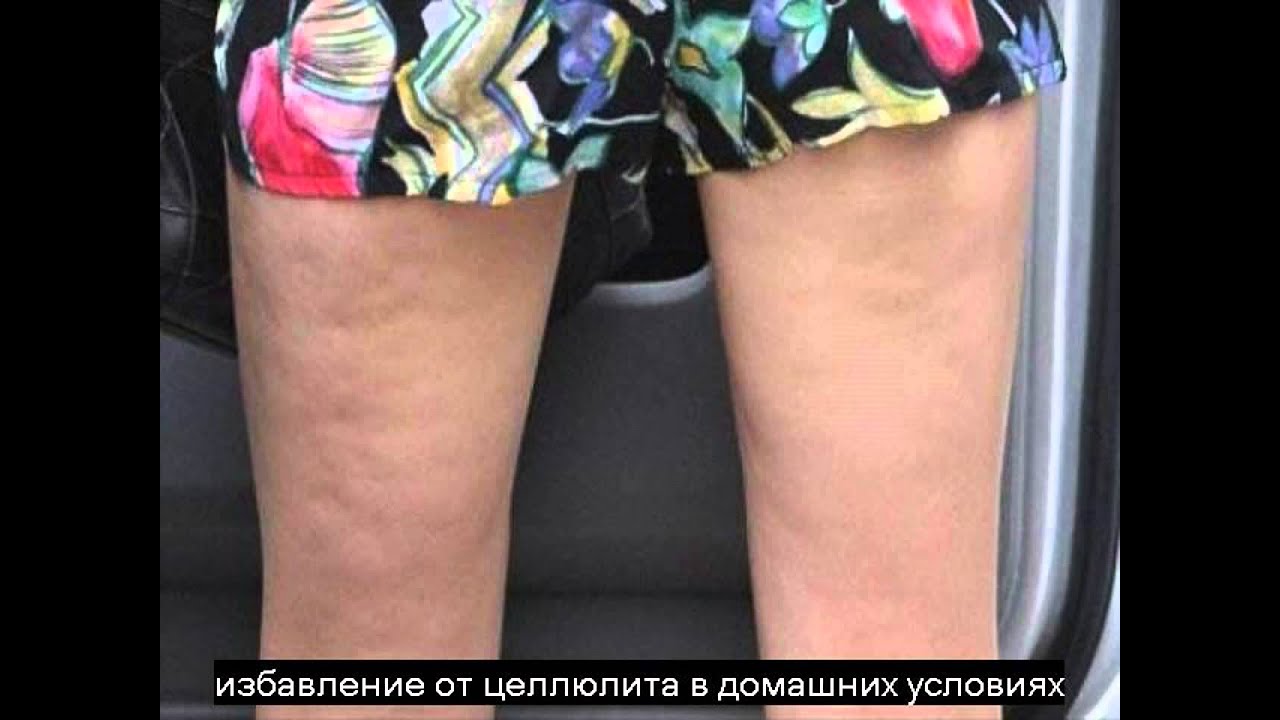 Отзывы о борьбе с целлюлитом в домашних условиях Отзывы о борьбе с целлюлитом в домашних условиях