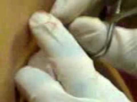 My rook piercing experience My rook piercing experience