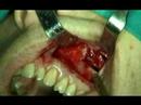 oral surgery video preview 10