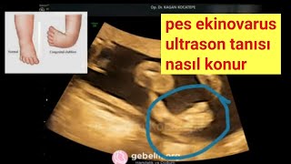 Doğumsal çarpık ayak (pes ekinovarus) - (clubfoot, PEV) ultrason tanısı nasıl konur, ne yapılır?