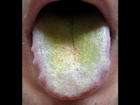 0 - Зелений наліт на язиці у дитини: причини, лікування, профілактика