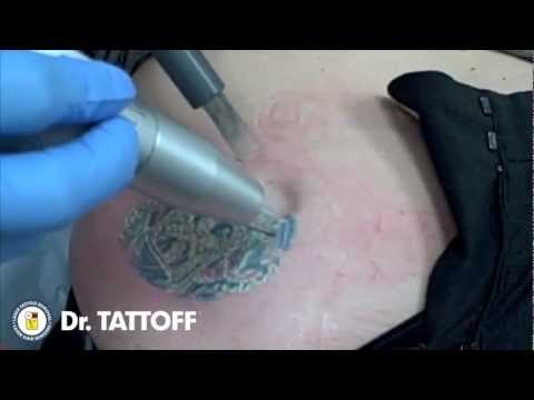 Koi Fish Tattoo Removal from Hip at Dr. TATTOFF in Santa ...