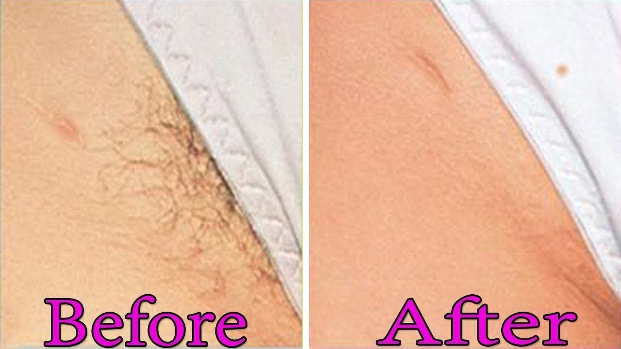 Bikini waxing photo before after