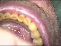Dental Implants - Dentsply's  Ankylos and Atlantis Combination - DR. GERARD CUOMO BOCA RATON FLORIDA