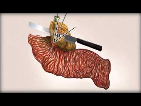 Whipple Procedure With Portal Vein Resection