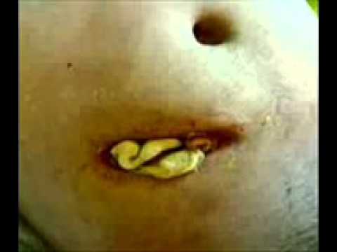 Peritonitis Definition