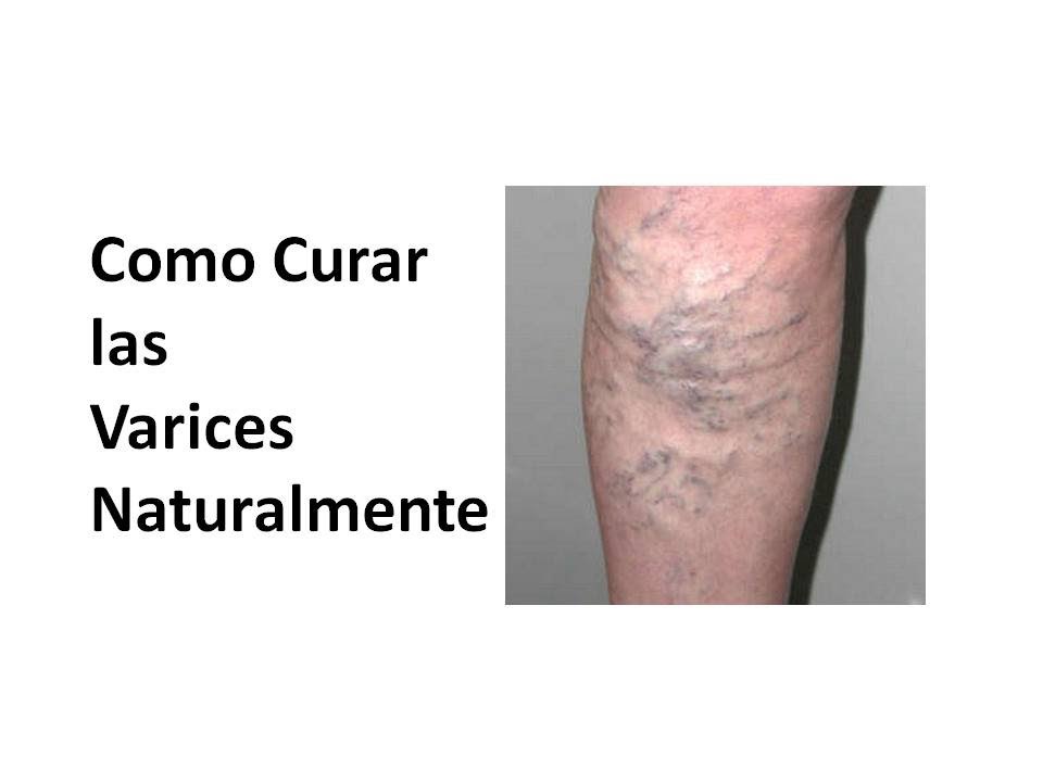 La crema buena contra el hongo de las uñas