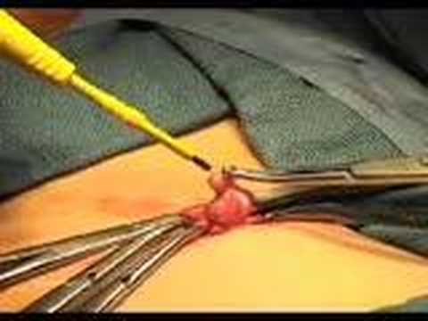 Appendectomy Operation