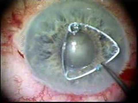 accommodating intraocular lens. The insertion of an intraocular lens (IOL) usually immediately follows 