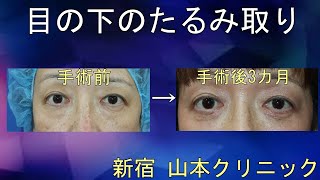 【目の下のたるみ】たるみの原因となる脂肪と余分な皮膚を切除します! 新宿 山本クリニック