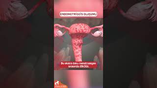 Endometriozis Oluşumu