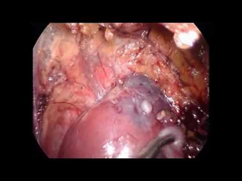 Los pinchazos de la osteocondrosis lumbar y