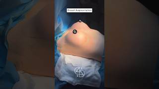 Breast Augmentation Dr. Ahmet Dilber